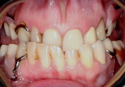 Closeup of smile with partial denture