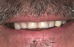 Closeup of severely worn teeth