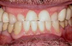 Closeup of worn teeth with collapsed bite