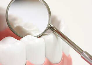 Teeth with sealants enlarged in dental mirror
