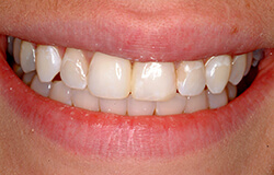 Smile after Diastema Repair in Marlton