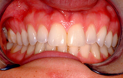 Smile following dental bonding to close gap between teeth