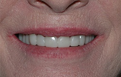 Smile following Snap-On Smile removable arch