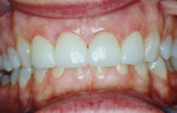 Closeup of corrected bite collapse