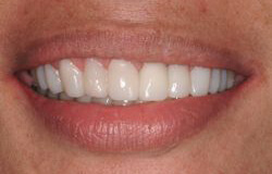 Smile After Dental reconstruction by Dr. Petulla & Kazemi