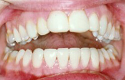 Smile after receiving Porcelain Veneers 