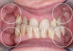 Closeup of tissue loss due to partial wear
