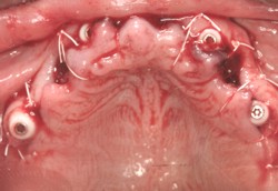 Closeup implant posts with gums sutured