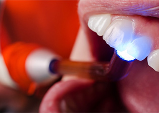 cosmetic tooth bonding
