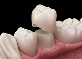 An illustration of a dental crown being placed over a damaged tooth 