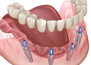 All-On-4 dentures