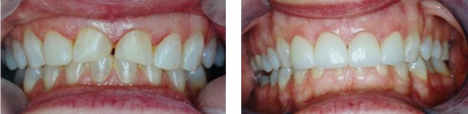 Smile before and after crowns and veneers