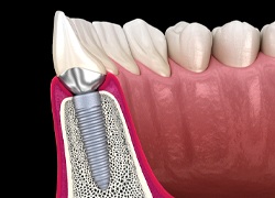 osseointegration illustration representing how dental implants work in Marlton