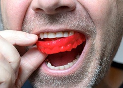 man putting a red mouthguard into his mouth