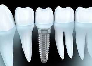 dental implant with crown in between natural teeth