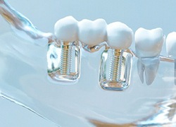 two dental implants supporting a dental bridge