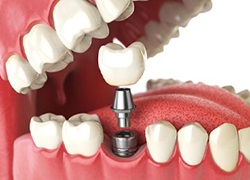 dental implant, abutment, and crown being placed in the jaw