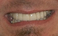 Closeup of repaired smile