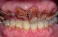 Closeup of teeth with severe decay