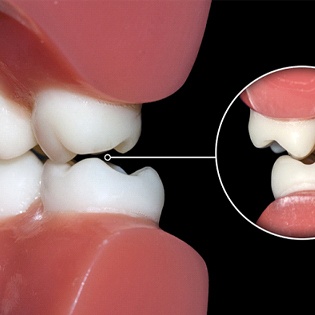 model of teeth grinding against each other