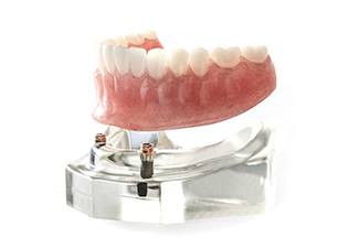 implant-retained denture