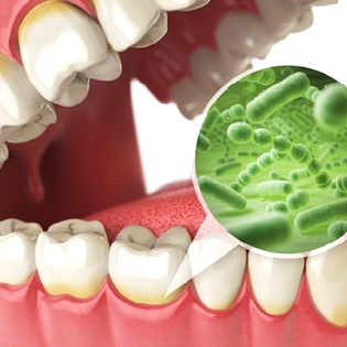Image of bacteria under the gums
