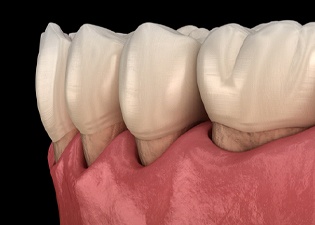 Digital image of gum recession