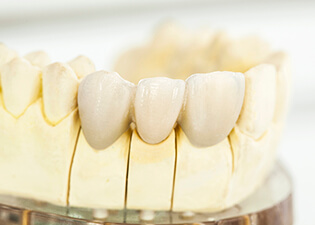 Dental model of fixed bridge restoration