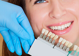 Smile compared with whitening chart