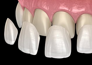 veneers being placed over the upper front teeth 