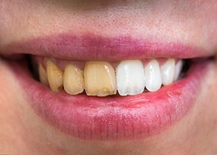 Before and after teeth whitening