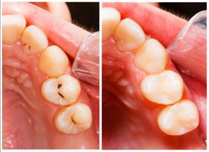 tooth-colored composite resin filling