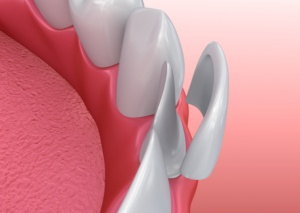 Model of porcelain veneer for lower tooth